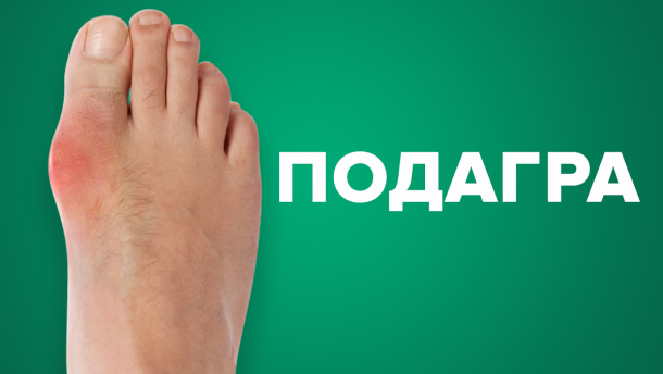 Что такое подагра: симптомы, причины и лечение болезни
